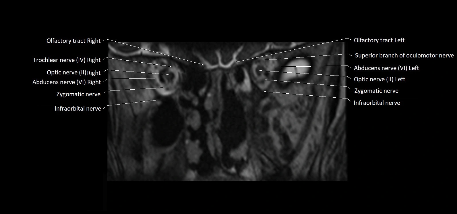 Cranial nerve cross sectional anatomy coronal 3T MRI image 11.webp
